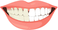 veneer-with-whitening